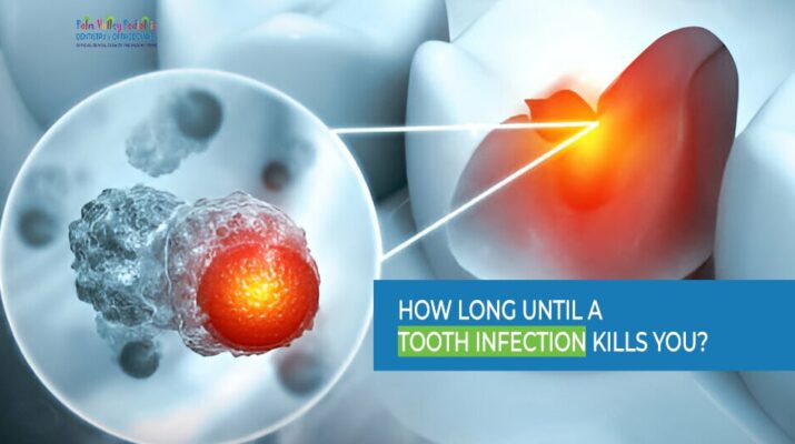 How Long Until a Tooth Infection Kills You